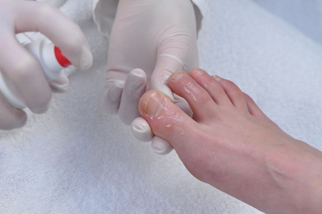 Treatment of fungus