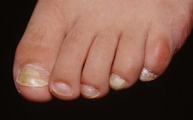 The reasons for the appearance of the fungus on the thumb of the leg