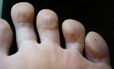 What does the fungus look like on the legs and how to treat it