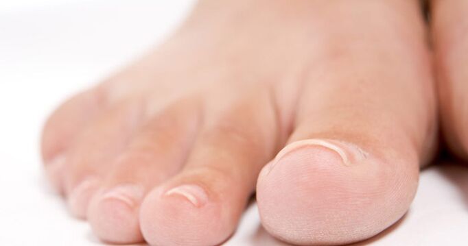 Toenails may be affected by a fungal infection